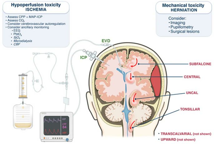 An excellent review in <a href="/yourICM/">Intensive Care Medicine</a> by <a href="/Dr_Cit/">Giuseppe Citerio</a> <a href="/chiara_robba/">Chiara Robba</a> - Intracranial pressure: current perspectives on physiology and monitoring. #neuroanesthesia #CriticalCare 
rdcu.be/cRQq9