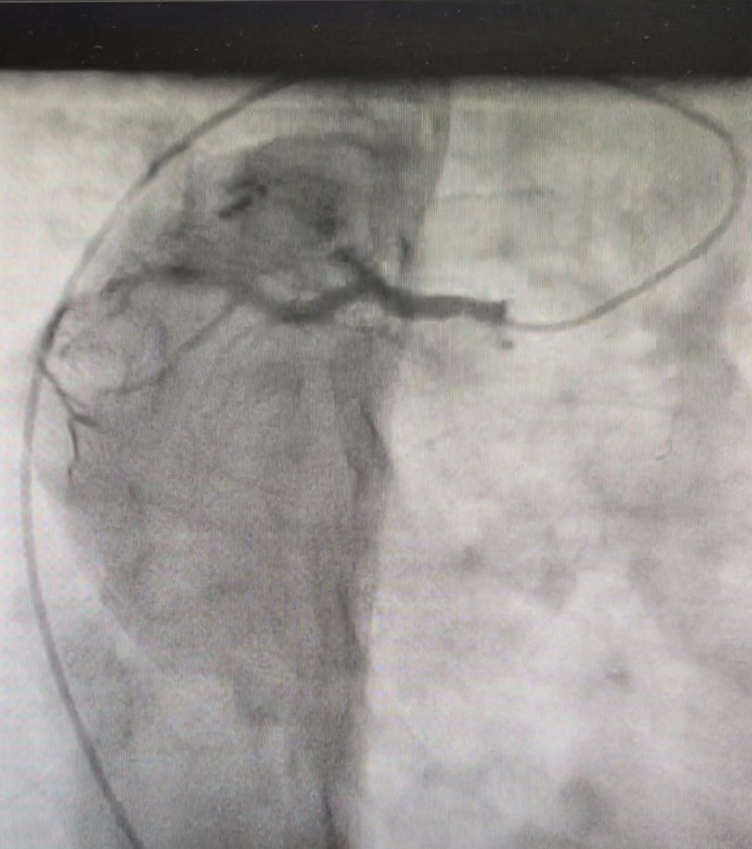 drsaurabhv's tweet photo. CABGon beating heart in Situs Inversus, Dextrocardia.I was standing on left side of the patient, considering the mirror image anatomy. RIMA was anastomosed to LAD. Total 3 grafts were needed.
This is a ‘Sinistral ‘ surgery ( odd for a right handed surgeon 🫳🏻) https://t.co/p9rgtLFqtO