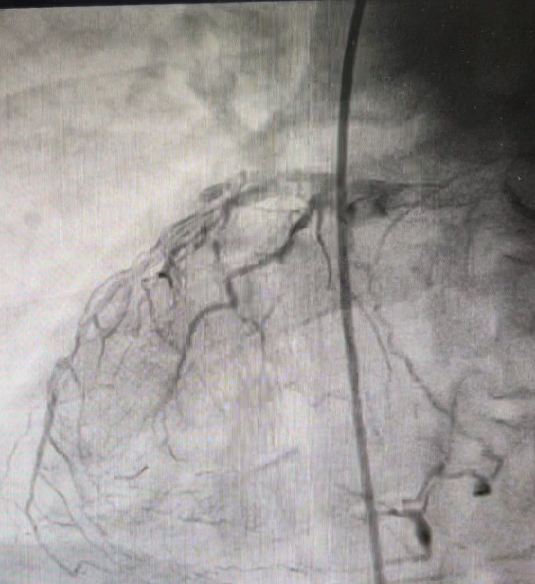 drsaurabhv's tweet photo. CABGon beating heart in Situs Inversus, Dextrocardia.I was standing on left side of the patient, considering the mirror image anatomy. RIMA was anastomosed to LAD. Total 3 grafts were needed.
This is a ‘Sinistral ‘ surgery ( odd for a right handed surgeon 🫳🏻) https://t.co/p9rgtLFqtO