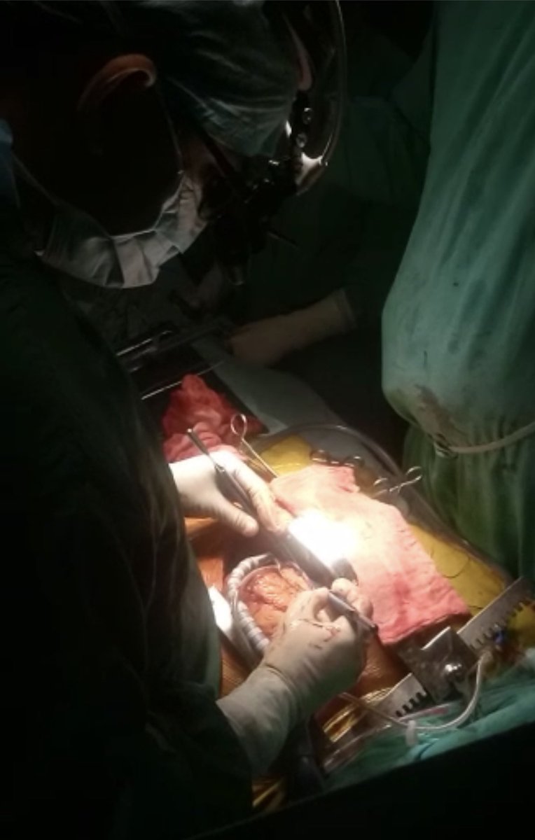 drsaurabhv's tweet photo. CABGon beating heart in Situs Inversus, Dextrocardia.I was standing on left side of the patient, considering the mirror image anatomy. RIMA was anastomosed to LAD. Total 3 grafts were needed.
This is a ‘Sinistral ‘ surgery ( odd for a right handed surgeon 🫳🏻) https://t.co/p9rgtLFqtO