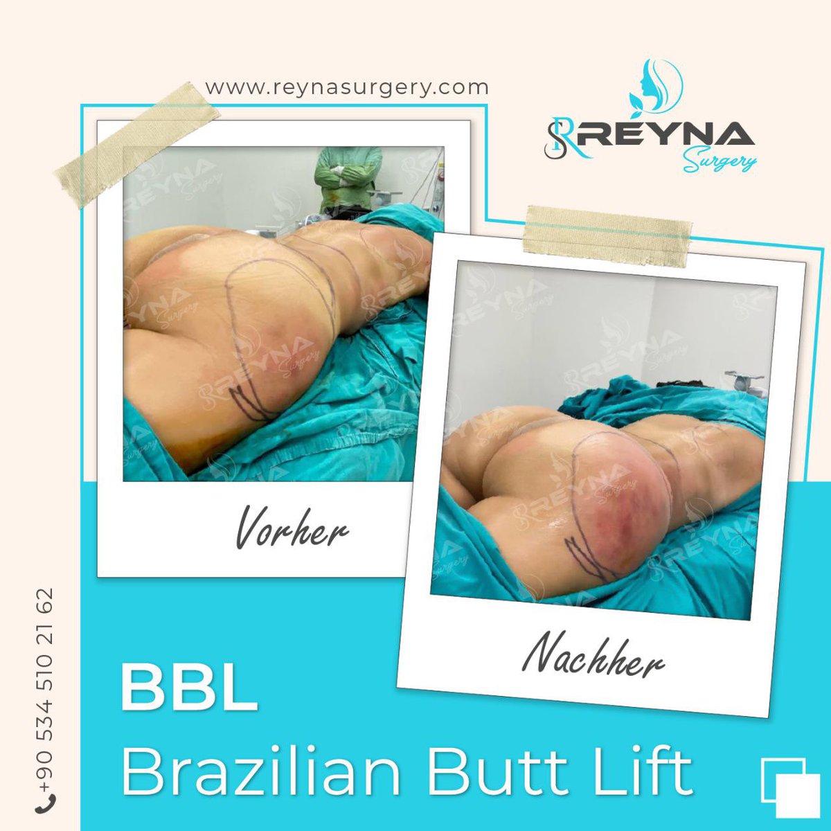 Brazilian Butt Lift.☘️

Yeni yaza sende hazırlan. Dümdüz bir karın, ince bel, dolgun ve yuvarlak kalça😍

📞 +90 534 510 2162

Çapa Tıp

#bbl #bblsurgery #brazilianbuttlift #po #polift
#schönerpo #urlaub #strand #bikinibody #plastischechirurgie #istanbul #türkei #reynasurgery