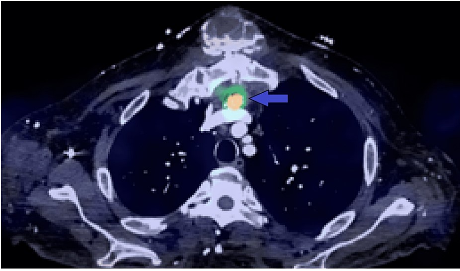 Happy to share our rare, yet interesting case of diagnosing tumoral calcinosis post CT surgery utilizing #YesCCT. @GTCardFellows @PhilLamMD @gabyweissman @fsheikh22 👇 bit.ly/3uUJJBG