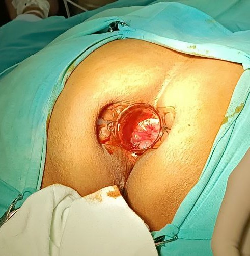 UcolorectaLPBol's tweet photo. Stapled hemorrhoidopexy in Jackson-knife position:
Our standard is different: in patient's with hemorrhoidal disease:
#hemorrhoidsurgery #hemorrhoids #hemorrhoidstreatment
#stappler #colorectalsurgery
#SoMe4Surgery @MISIRG1 @SAGES_Updates  @debby_keller @almagoch
@colorectaltweet https://t.co/Gpqrk6Rdkf