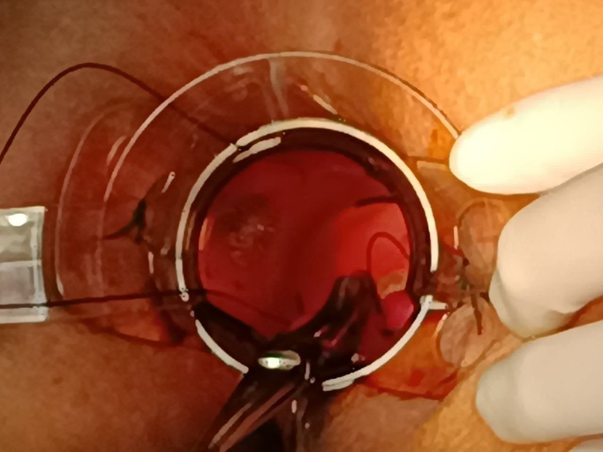 UcolorectaLPBol's tweet photo. Stapled hemorrhoidopexy in Jackson-knife position:
Our standard is different: in patient's with hemorrhoidal disease:
#hemorrhoidsurgery #hemorrhoids #hemorrhoidstreatment
#stappler #colorectalsurgery
#SoMe4Surgery @MISIRG1 @SAGES_Updates  @debby_keller @almagoch
@colorectaltweet https://t.co/Gpqrk6Rdkf