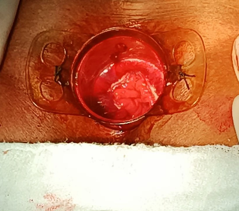 UcolorectaLPBol's tweet photo. Antonio Longo presented his original results of SH in 144 patients during the 1998 World Endoscopic Meeting in Rome. We are more comfortable with this position and it's more ergonomic for the surgeon and the patient throughout all the procedure and the firing of the PPH stappler https://t.co/m8tht1i3eE