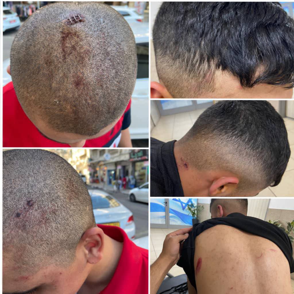 Signs of beating appear on the two Palestinian young men Shadi and Ahmad Jabareen from Anata who were aggressively assaulted by the Israeli occupation forces during their arrest earlier today at dawn.