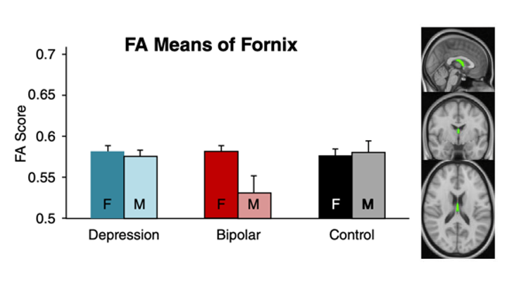 💥 New paper out 💥 Our study of white matter integrity in youth with mood disorders ➡️ The fornix may be vulnerable to very early neurological insults; bipolar disorder males seem most sensitive to this... onlinelibrary.wiley.com/doi/full/10.11…