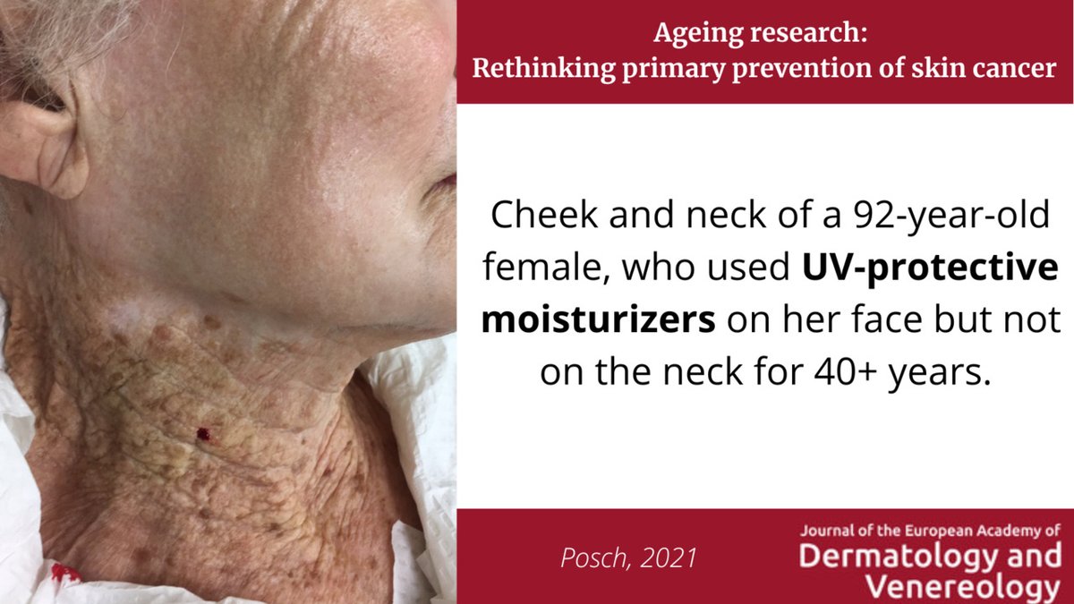 Read this commentary by <a href="/PoschChristian/">Christian Posch M.D. Ph.D. MBA</a> to learn about how focusing efforts on both exogenous (UV-protection) and endogenous (#aging) risk factors for #SkinCancer development has the potential to reduce incidence at unprecedented rates.👉bit.ly/3BSkNfJ
#sunscreen