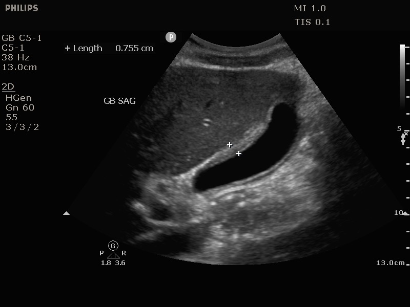 MH_EMultrasound's tweet photo. Pt with gallbladder wall thickening and free fluid from CHF fluid overload.  Remember, there are a lot of things that can cause GB wall thickening, not just primary biliary disease.  #POCUS #Ultrasound #FOAMed #FOAMus #Gallbladder https://t.co/kpQK9eU5lp