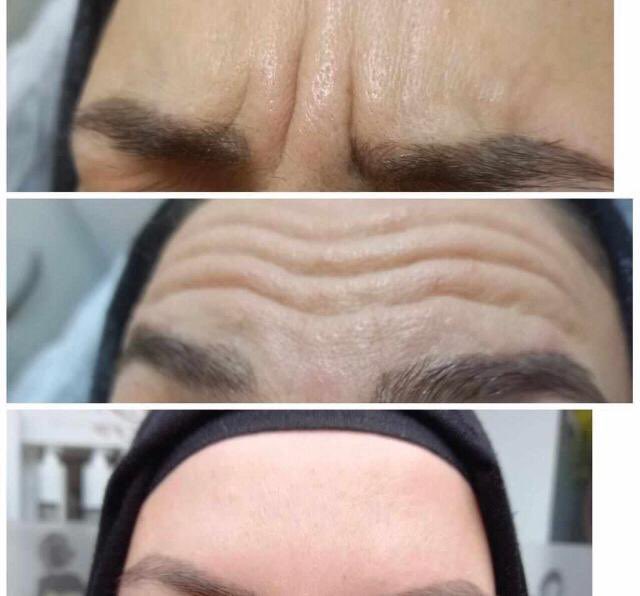 Randevu almayı
Unutmayın, 5333929350
Cildine bakın , 
#botox 
#yuzdolgu