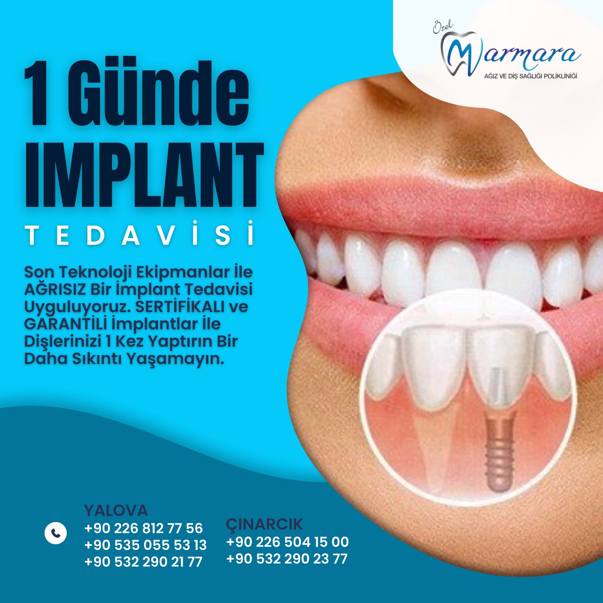 Sağlıklı dişler ve gülüşler dileriz. ozelmarmaradent.com.tr

📌Yalova Şube
☎️ +90 226 812 77 56
☎️ +90 535 055 53 13
☎️ +90 532 290 21 77

📌Çınarcık Şube
☎️ 0 226 504 15 00
☎️ 0 532 290 23 77
.
.
..
#ozelmarmaradent #dişapsesi #20likdiş #diştaşıtemizliği #zirkonyum #implant