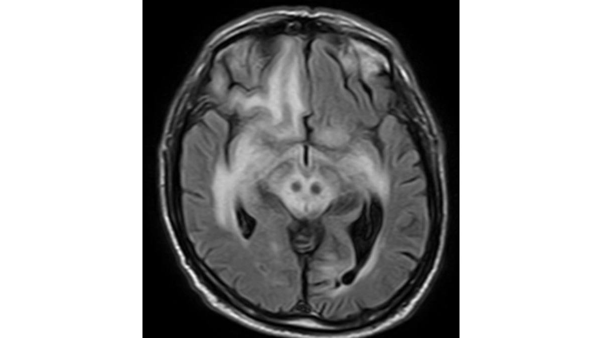 XRPL__A's tweet photo. Dx conundrum; A 74 yr old 👨 with progressive left hemiparesis, cognitive impairment. o/e Stuporous, b/l extensor plantars. MRI https://t.co/ogRt0R3bKK
