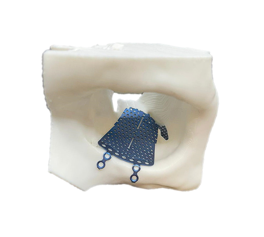 FabLab 3D Hospital Marañón (@3d_maranon) on Twitter photo Shaping of an orbital reconstruction plate using a 3D printed anatomical model.
<a href="/3d_maranon/">FabLab 3D Hospital Marañón</a>, Dr. Alberto Díez Montiel, Dr. Saad Khayat, <a href="/rupermac/">Rubén Pérez-Mañanes, MD PhD</a>, <a href="/calvoharo_ja/">José Antonio Calvo</a>, <a href="/IagoDqbito/">Iago González</a>
#UPAM3D #HospitalGregorioMaranon #impresion3D Shaping of an orbital reconstruction plate using a 3D printed anatomical model.
<a href="/3d_maranon/">FabLab 3D Hospital Marañón</a>, Dr. Alberto Díez Montiel, Dr. Saad Khayat, <a href="/rupermac/">Rubén Pérez-Mañanes, MD PhD</a>, <a href="/calvoharo_ja/">José Antonio Calvo</a>, <a href="/IagoDqbito/">Iago González</a>
#UPAM3D #HospitalGregorioMaranon #impresion3D