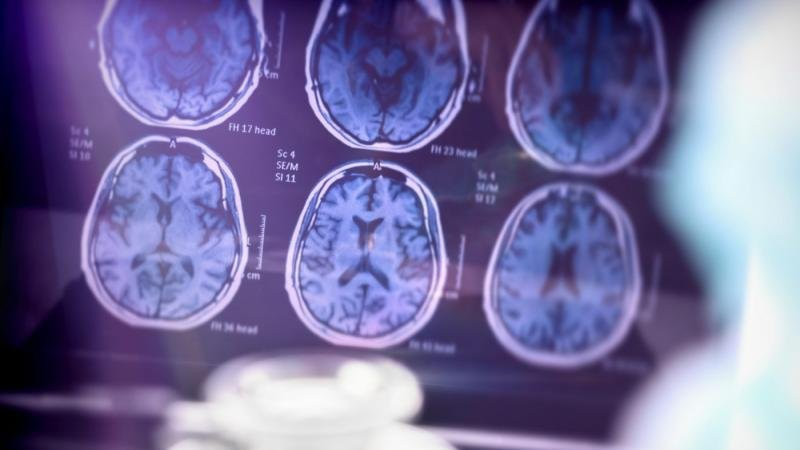 Researchers <a href="/imperialcollege/">Imperial College London</a> have developed an #AI #machinelearning tool that can diagnose #Alzheimers #disease at an early stage from a single MRI #brain scan, with the potential to significantly improve #clinical decision-making.

Learn more in @GENBio: rb.gy/qsdwee