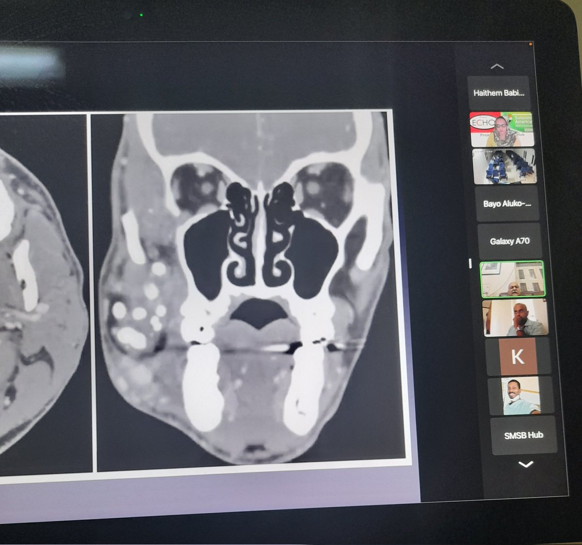 SafaaMerghani's tweet photo. #Knowlege_without_barriers
#علم٠بلا٠قيود
#OMFSECHO
#ProjectECHO
#ProjectECHOSAMA
We were delighted last Saturday to have a fantastic session on vascular anomalies, which was presented by Prof, Sanjiv Nair to 102 learners, and greatly moderated by Dr Amol Kulkarni
@SudAmeriMedAsn https://t.co/YgJtxJZmeE
