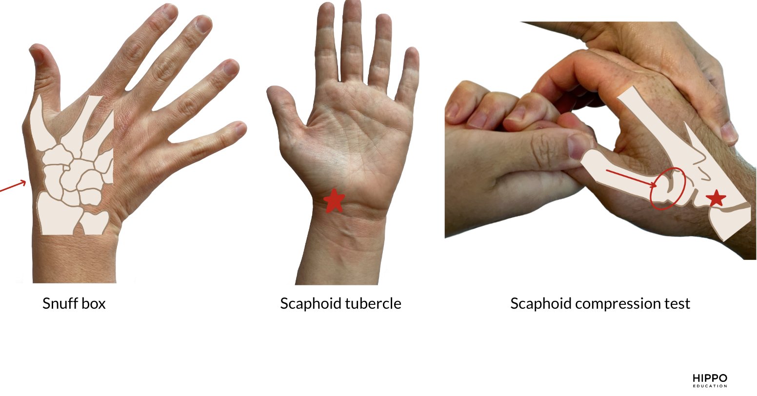 Roger Wu on Twitter: "Fractures are generally top-of-mind, but do not  forget ligamentous injuries. Scapholunate injuries (MCC of carpal  instability) present with tenderness just distal to Lister\