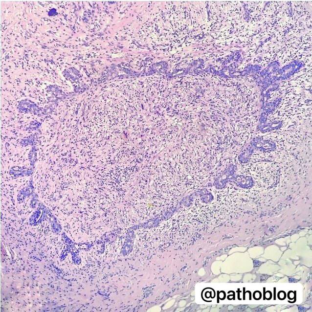 pathoblog's tweet photo. This phenomenon is called «garland pattern» — obliteration of the ductal lumen observed in the last stage of ectasia. After obliteration, the lumen recanalizes at the periphery. 
#PathTwitter #breastpath #pathresidents https://t.co/XyQTyNarrH