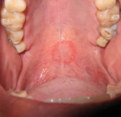 สำหรับคนที่สงสัย เวลามี oral sex จะเป็นรอยกลมๆแบบนี้ หมอฟันเห็นกันเป็นปกติ(โดยเฉพาะหลังวันวาเลนไทน์) รอยจะหายไปเองใน1อาทิตย์จ้า