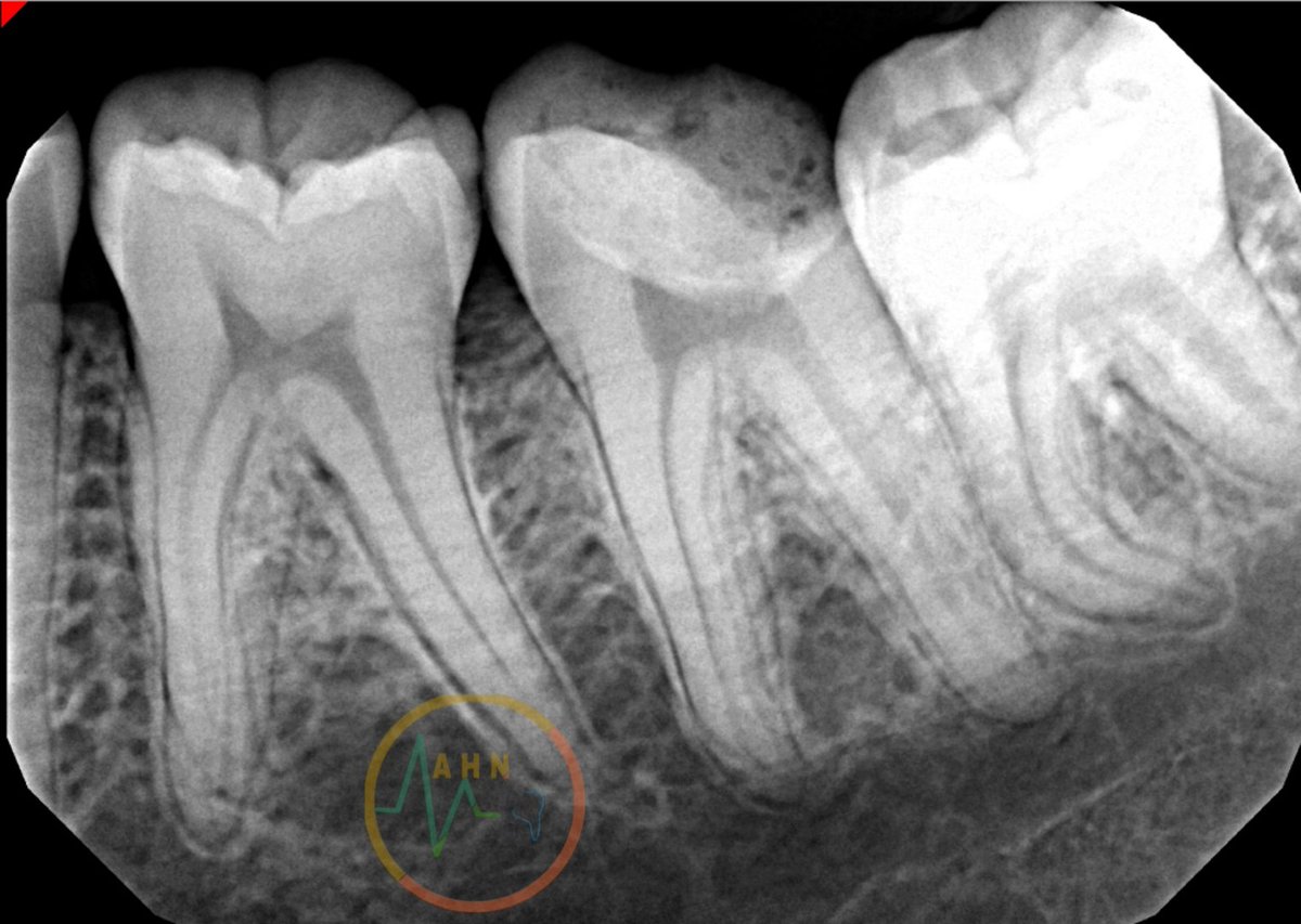 dentist_amar617's tweet photo. RCT for grossly decayed mandibular 2nd molar (37)
Caries were removed and missed wall built up.
Canals Shaped using raceEVO 6%sequence
BC sealer were used
#endo #SaveTooth #dent17 https://t.co/gNfjqiZp1y