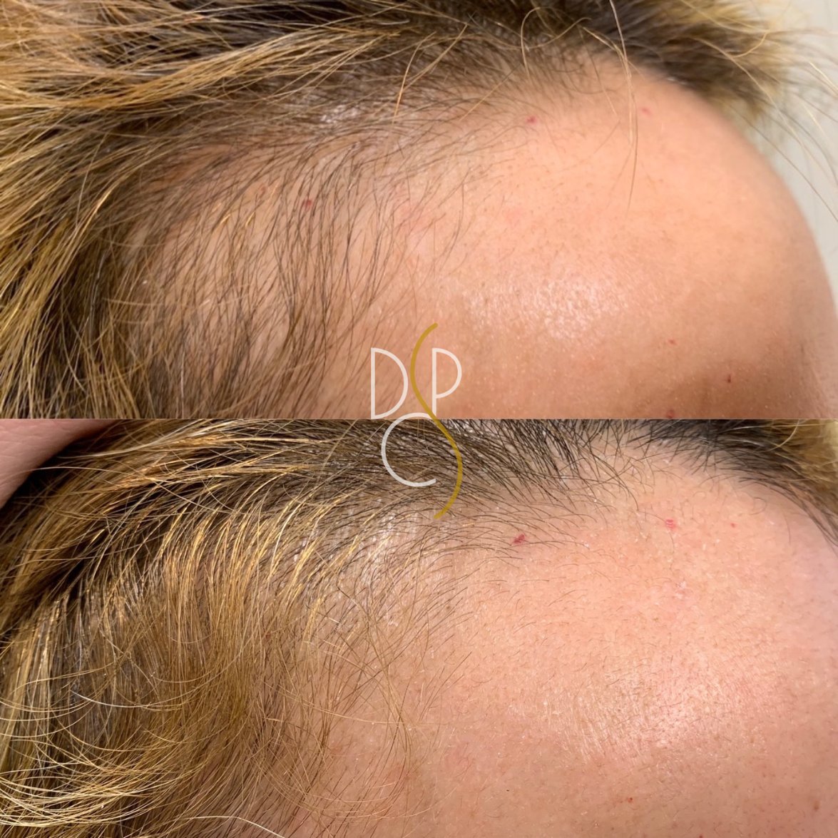 More remarkable results from Platelet-Rich Plasma (PRP) injections 💉 A thicker &amp; fuller head of hair results in more confidence. ✨

Contact Davis Cosmetic Plastic Surgery to find out about the different ways we utilize PRP:
daviscps.com/davis-cosmetic…
