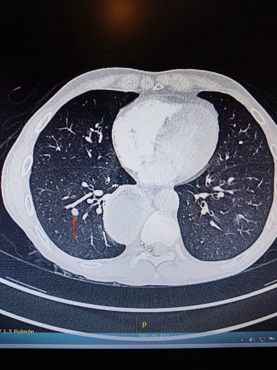 Mariajosebernab's tweet photo. Continuamos creciendo; Navegador electromagnético Illumisate @Medtronic  + minisonda radial @Olympus  + fluoroscopia. PAAF -ROSE: positivo para malignidad. Varón 57 años con Ap; ADC esofágico. Nódulo 7 mm LID (SUVmáx 5,8).  Neumología y Cirugía Torácica #somosClinico #lungcancer https://t.co/tTBE7FyAJo