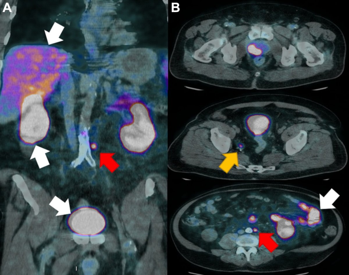 RadioGraphics (@radiographics) on Twitter photo This online #RGFundamentals presentation reviews current strengths and limitations of prostate cancer imaging and explores novel imaging modalities and imaging-based precision medicine on the horizon. <a href="/diegodns/">Diego dos Santos</a> <a href="/natallyhorvat/">Natally Horvat, MD, PhD</a> <a href="/AdrianoDiasRad/">Adriano Dias</a> bit.ly/3uuQqu1 This online #RGFundamentals presentation reviews current strengths and limitations of prostate cancer imaging and explores novel imaging modalities and imaging-based precision medicine on the horizon. <a href="/diegodns/">Diego dos Santos</a> <a href="/natallyhorvat/">Natally Horvat, MD, PhD</a> <a href="/AdrianoDiasRad/">Adriano Dias</a> bit.ly/3uuQqu1
