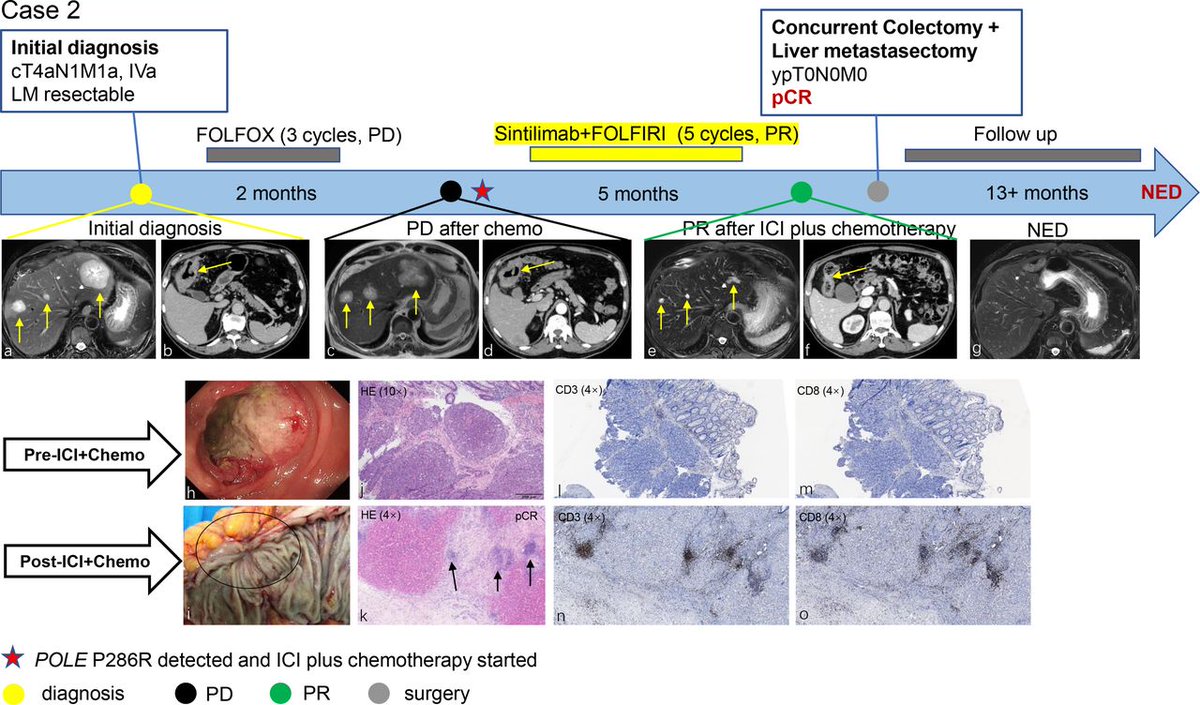jitcancer's tweet photo. New #JITC short report: Pathological complete response to immune checkpoint inhibitor in patients with colorectal cancer liver metastases harboring POLE exonuclease domain mutation https://t.co/GoV4JGWjaI https://t.co/EgwC7GGD8f