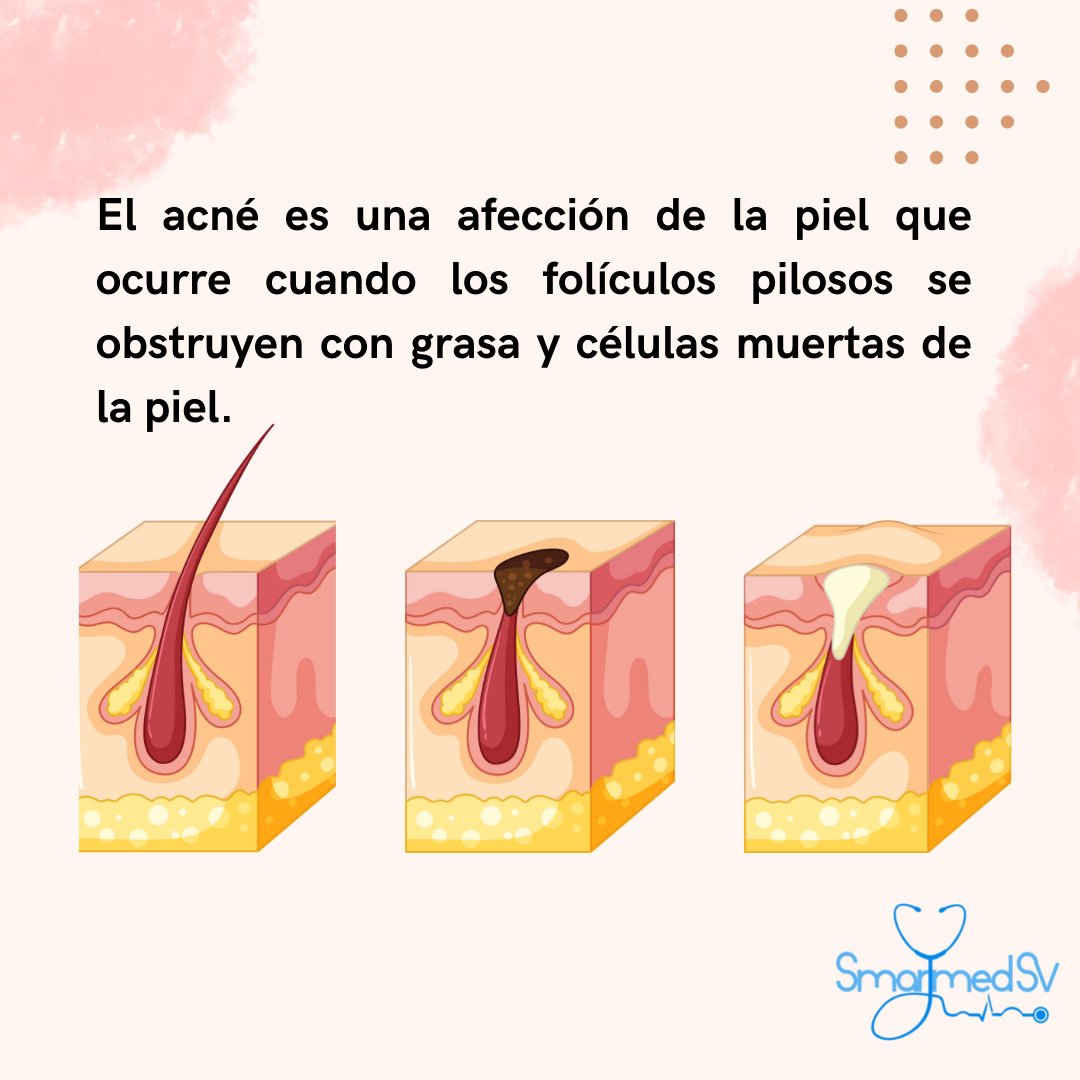 SmartMed_sv's tweet photo. Hablemos sobre 🔹Acne🔹
Escrito por Dra. Kathya Jimenez. 
@KathyaJimenezMD  
#SmartMed_sv  
#smarttalksv https://t.co/SHpa25Zz2s
