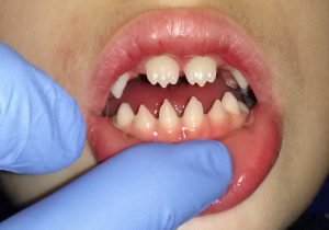 laboratoriosje's tweet photo. ***Estigmas de sífilis prenatal:

-Tríada de Hutchinson: sordera neural del par craneal VIII, dientes en destornillador y queratitis intersticial
-Nariz en silla de montar
-Mandíbula en bulldog
-Arcada palatina alta
-Agadías
-Tibia en sable
-Frente olímpica
-Protuberancia frontal https://t.co/1EK7llHEaZ