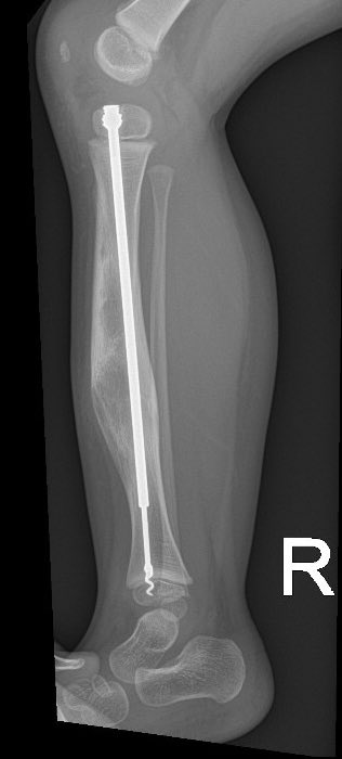 Jürgen Messner (@paedsorthopod) on Twitter photo Osteofibrous dysplasia in 2 year old with pathological # (procurvatum and varus deformity) stabilised with telescoping rod, 4 months later no new fractures even with falls. #osteofibrousdysplasia #orthotwitter <a href="/OrthoPaeds/">Edinburgh Children’s Orthopaedics</a> <a href="/EdinOrthopaedic/">Edinburgh Orthopaedics</a> (images with permission) Osteofibrous dysplasia in 2 year old with pathological # (procurvatum and varus deformity) stabilised with telescoping rod, 4 months later no new fractures even with falls. #osteofibrousdysplasia #orthotwitter <a href="/OrthoPaeds/">Edinburgh Children’s Orthopaedics</a> <a href="/EdinOrthopaedic/">Edinburgh Orthopaedics</a> (images with permission)
