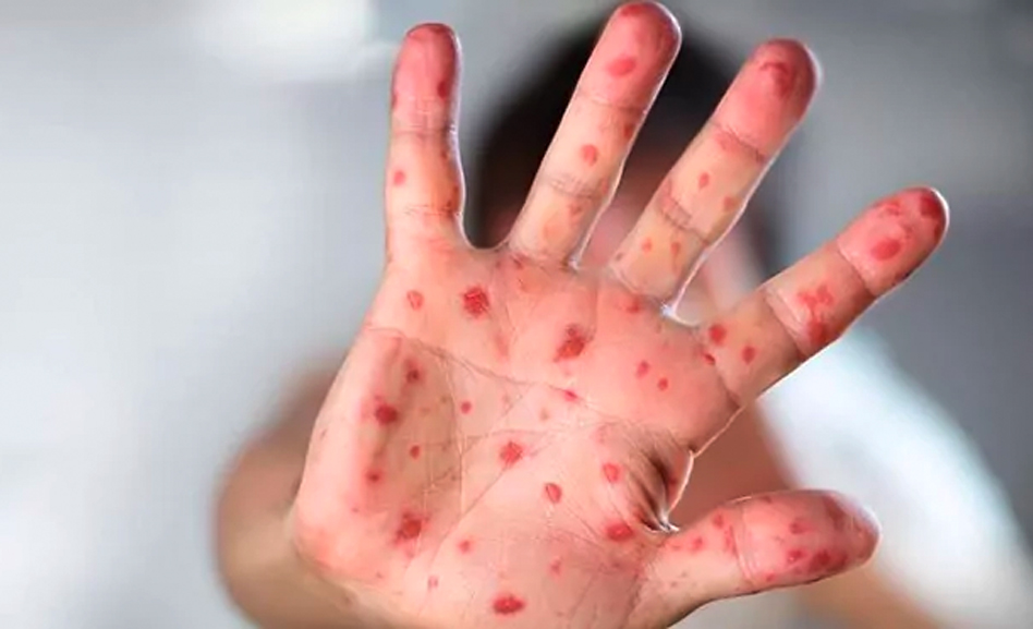 DallasVoice's tweet photo. Daddyland party-goer diagnosed with monkeypox https://t.co/shznJkZNFX https://t.co/p1cY8ebEwv