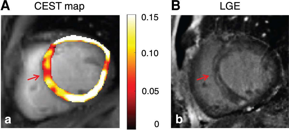 Henry Han (@hancardiomd) on Twitter photo Magnetic resonance imaging of cardiac metabolism in #HeartFailure : how far have we come?
Key parameters of cardiac metabolic #MRI for the assessment of myocardial #metabolism in #HF
#WhyCMR #EHJCVI
academic.oup.com/ehjcimaging/ad… <a href="/ESC_Journals/">European Society of Cardiology Journals</a> <a href="/Cosyns/">Cosyns Bernard</a> <a href="/denisamuraru/">Denisa Muraru</a> <a href="/Sarah_Moharem/">Sarah Moharem Elgamal, MBBCh, MSc, PhD👩🏻⚕️🫀</a> Magnetic resonance imaging of cardiac metabolism in #HeartFailure : how far have we come?
Key parameters of cardiac metabolic #MRI for the assessment of myocardial #metabolism in #HF
#WhyCMR #EHJCVI
academic.oup.com/ehjcimaging/ad… <a href="/ESC_Journals/">European Society of Cardiology Journals</a> <a href="/Cosyns/">Cosyns Bernard</a> <a href="/denisamuraru/">Denisa Muraru</a> <a href="/Sarah_Moharem/">Sarah Moharem Elgamal, MBBCh, MSc, PhD👩🏻⚕️🫀</a>