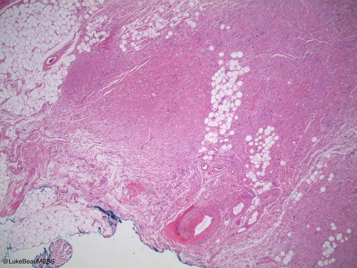 LukeBeauMBBS's tweet photo. Just found this in my collection and thought I’d post it. Historic case. No history due to rarity of disease.
#pathology #pathtwitter #dermpath
Answer: https://t.co/Q5rkmnOoEP https://t.co/MOZsV4T5SL