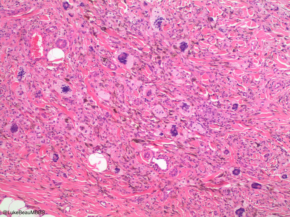 LukeBeauMBBS's tweet photo. Just found this in my collection and thought I’d post it. Historic case. No history due to rarity of disease.
#pathology #pathtwitter #dermpath
Answer: https://t.co/Q5rkmnOoEP https://t.co/MOZsV4T5SL