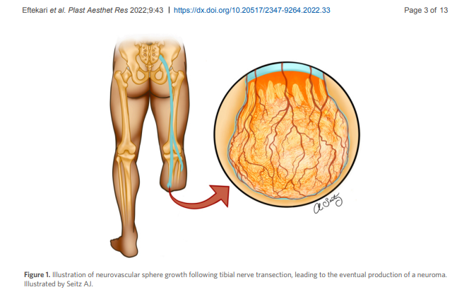 PARjournal's tweet photo. #Neuromas #Targeted muscle #Amputation
A valuable review titled Management of symptomatic neuromas: a narrative review of the most common surgical treatment modalities in amputees from Dr. Samuel O. Poore's team.
Online: https://t.co/ScuxEMHnxT
Welcome to read and share it! https://t.co/Wmlq0Ud9iG
