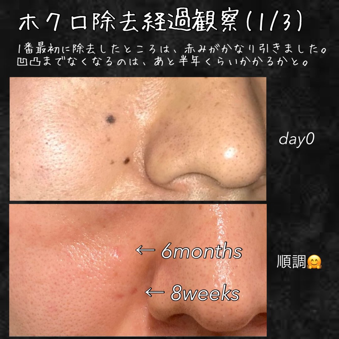 tk_hadakaizen's tweet photo. ホクロ除去の経過観察です！
順調に赤みもひいてきてます。脂肪が多い頬は少し進捗が遅い印象です。
そして紫外線は絶対NGなので、日焼け止め塗りたくってます🙇‍♂️
ホクロ除去を検討している方に、少しでも参考になれば🤗
#ホクロ除去 #ほくろ除去 #ホクロ取り #ほくろ取り https://t.co/BRDlCqbk6a