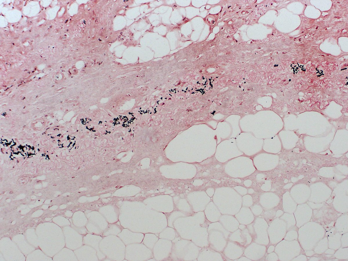 Peri-eccrine calcification and PXE-like elastic fibre calcification are two common, but probably not very specific, findings in calciphylaxis.pubmed.ncbi.nlm.nih.gov/31192861/  Stain is von Kossa.  #dermpath #pathology #dermatology