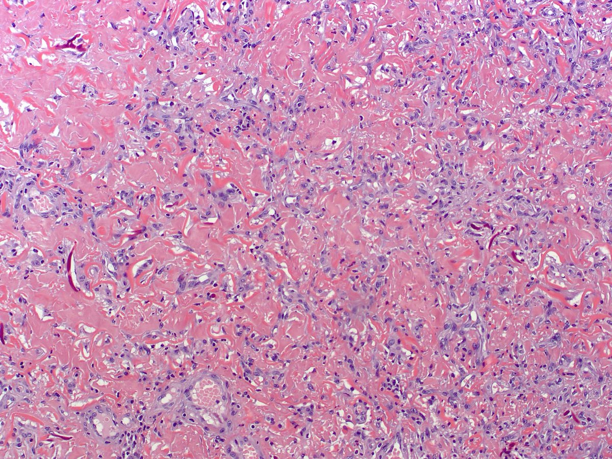 Diffuse dermal angiomatosis is fairly common in calciphylaxis.  In the appropriate context it seems quite specific; the other time we commonly see it is in pendulous breast skin.  pubmed.ncbi.nlm.nih.gov/19652584/  #dermpath #dermatology #pathology