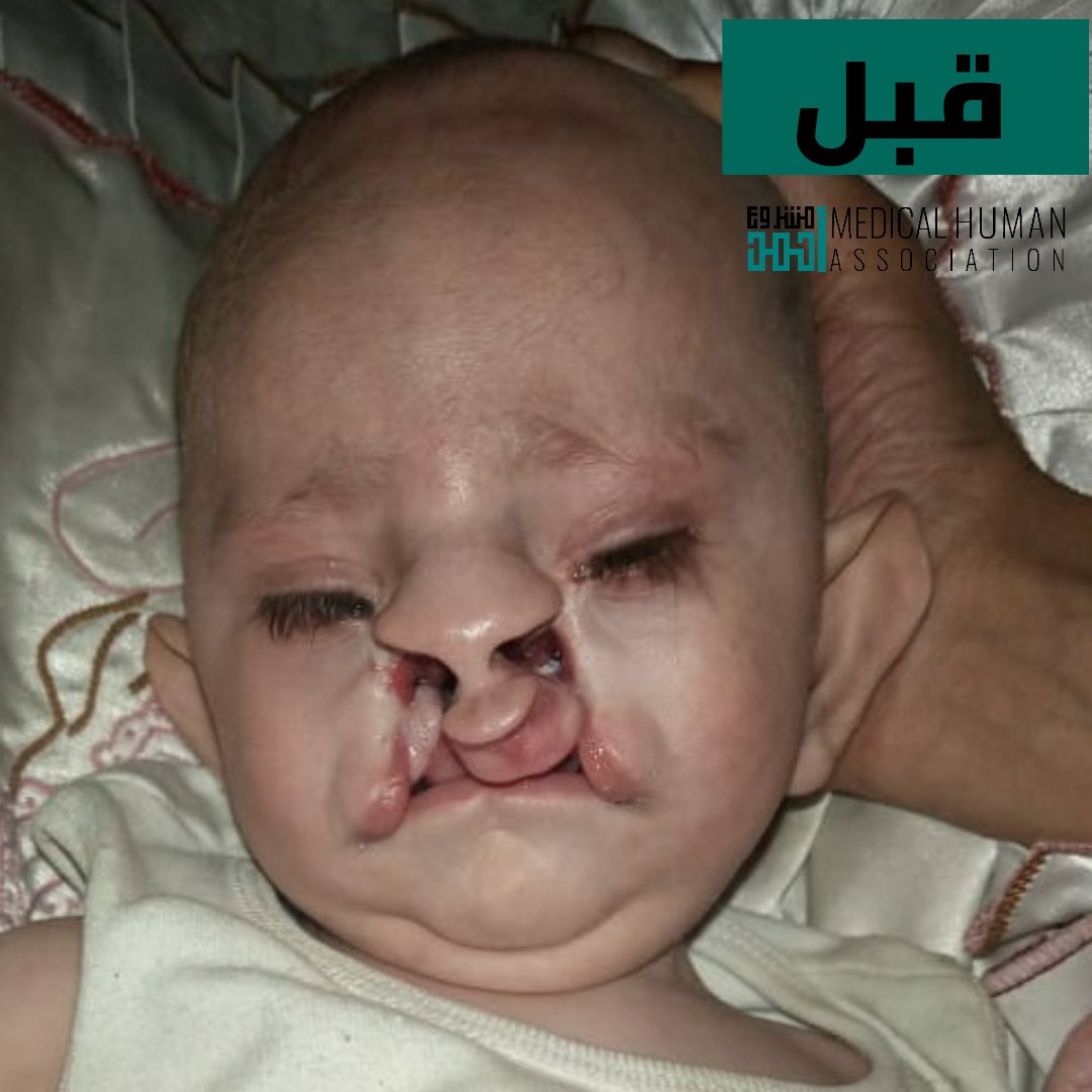 Meddose1's tweet photo. من أندر العمليات حول العالم ( انشقاق شفة ثنائي الجانب مع انشقاق وجه درجة ثالثة ) تمت في مشروع أحمد الإنساني بنصف القيمة 💜💜💜

@DrAhmadNMohamm1 https://t.co/B01ONm9F4k