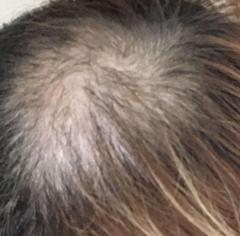 薄毛からのサクセスストーリ Usugefukkatsu Twitter