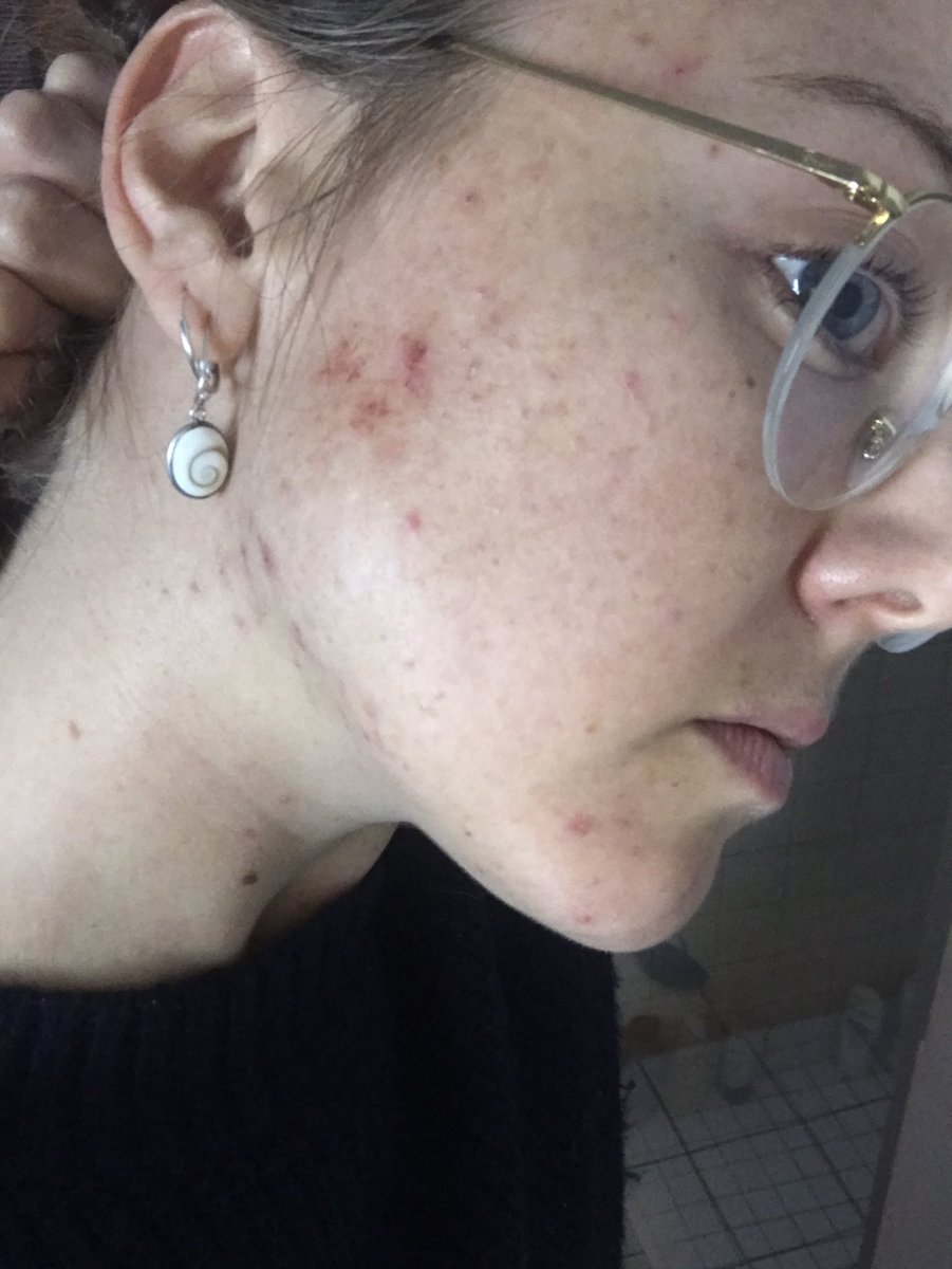 katieconrad's tweet photo. @swiitchbeauty PLEASE PLEASE HELP ME - I don’t know what to do anymore  (Ps I don’t even have good camera quality in these pictures🥴) https://t.co/XogLhxT9a3