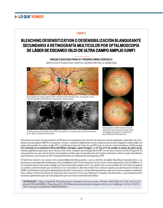 Este caso fue presentado por los Dres. <a href="/RodrigoAbreuMD/">Rodrigo Abreu MD PhD MBA</a>  y Gonzalo Quezada, en la sección LO QUE VEMOS, del último número de Mácula On. Accede al contenido completo de la revista desde este enlace 👉clubespanoldelamacula.es/numero-8/ #ConocimientosCompartidos #EspírituCEM
