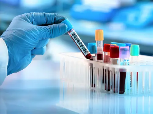 MRC_Uganda's tweet photo. Is Hepatitis B associated with cancer?
Novel research by Abram Kamiza, @SFatumo &amp; @tchikowore1 examines the relationship between chronic hepatitis B infection &amp; the development of several cancers, including those of the liver, stomach &amp; cervix.
Read more: https://t.co/KwposHMcv4 https://t.co/WRP4wSLRSt