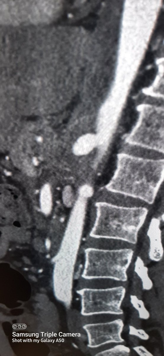 Badri (@badrivv) on Twitter photo On my last day at St Mary's Hospital, I assisted a Type 4 aortic repair for celiac a. aneurysm and this completes my BSET fellowship training in London.
I was lucky enough to work with experts in Vascular Surgery.
Thank you team. <a href="/Colinbicknell/">Colin Bicknell</a> <a href="/BSETnews/">BSET</a> <a href="/vascularsurgeon/">Patrick Chong</a> On my last day at St Mary's Hospital, I assisted a Type 4 aortic repair for celiac a. aneurysm and this completes my BSET fellowship training in London.
I was lucky enough to work with experts in Vascular Surgery.
Thank you team. <a href="/Colinbicknell/">Colin Bicknell</a> <a href="/BSETnews/">BSET</a> <a href="/vascularsurgeon/">Patrick Chong</a>