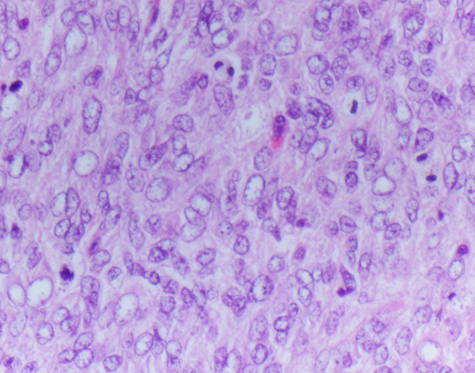 Niño de 8 meses de Guatemala acude a la atención clínica por un tumor de crecimiento rápido en la región cervico-occipital. Se realizó una resección total. Por IHC el tumor es positivo para CD99, TLE1 y SATB2. Los estudios moleculares están pendientes.
Autor: <a href="/NMShillingford/">Nick Shillingford</a>