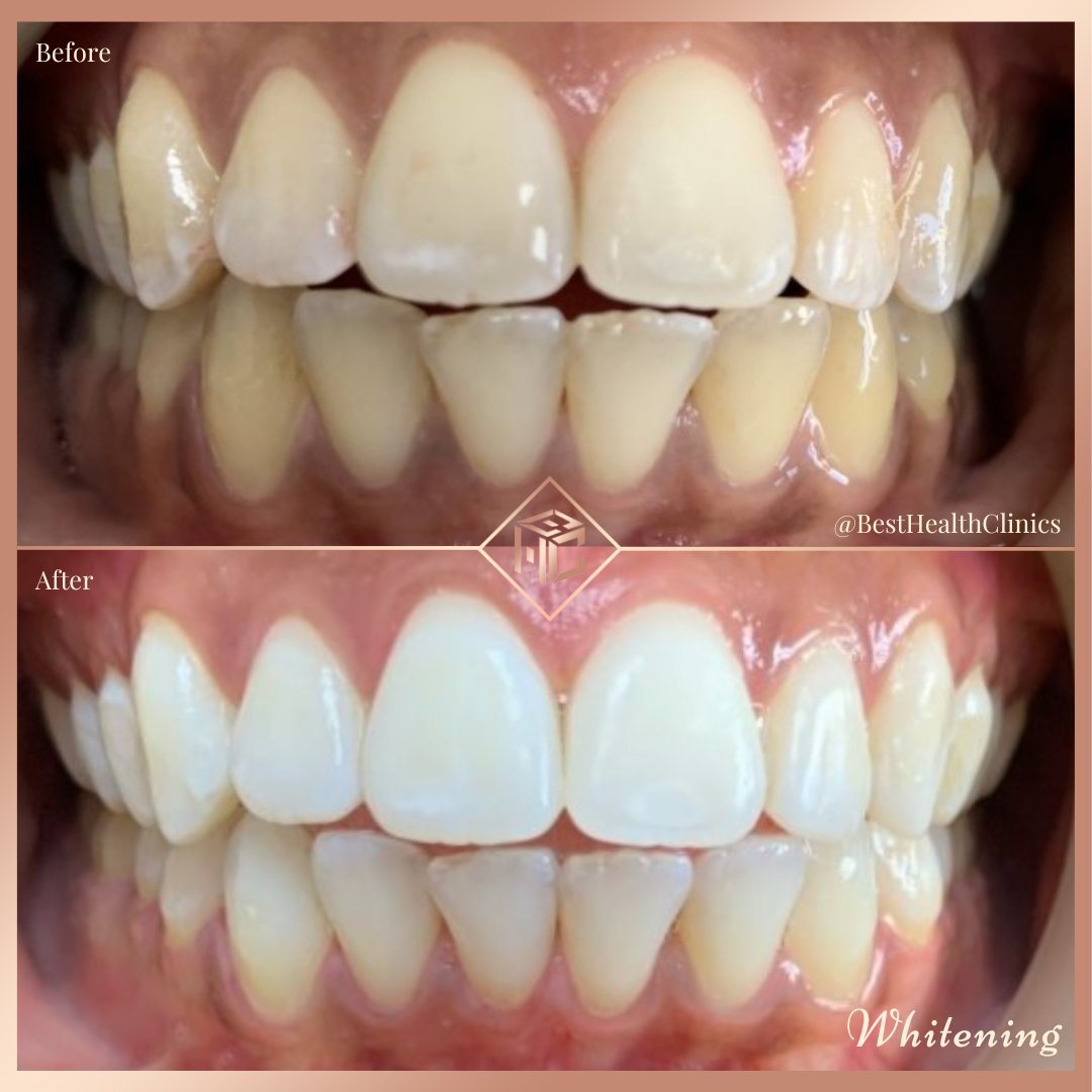 Enlighten teeth whitening - 🦷
▫️2 weeks at home whitening
▫️1 hour in surgery whitening
▫️Pain free!
Icon treatment - 🦷
▫️Removal of white spots on your teeth
▫️No drilling
▫️One visit
▫️Safe and effective

📞call us - 01708 477 577
📧 email us - info@bhclincs.com