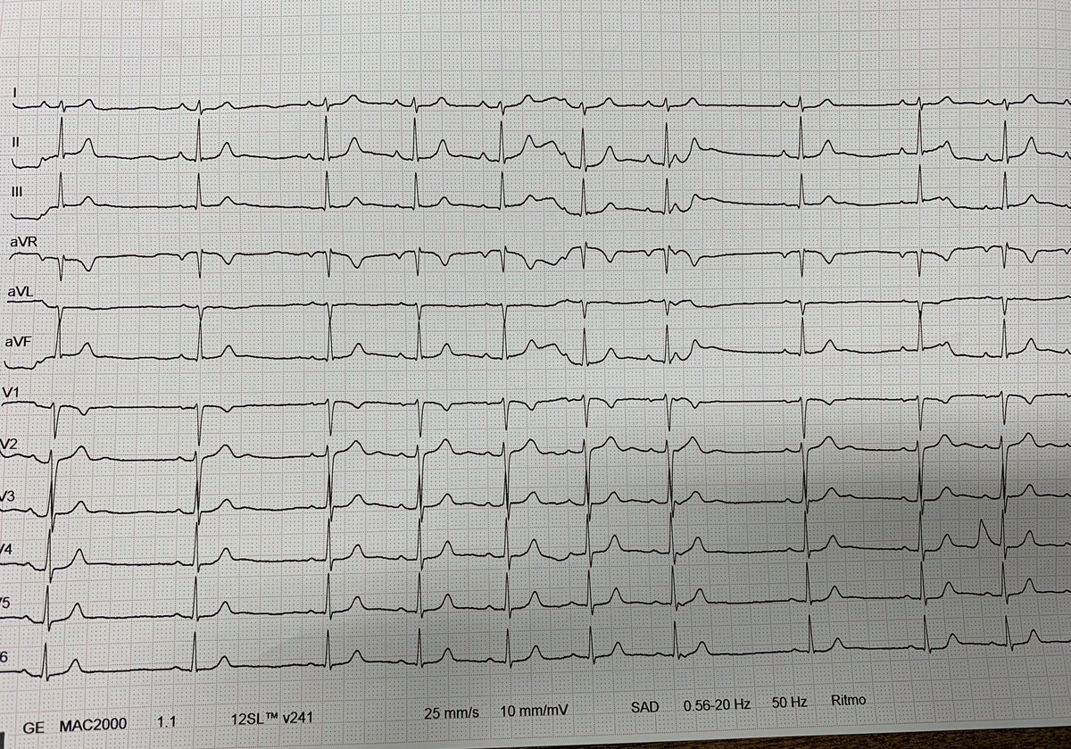 Electro en la consulta de cardio pediátrica de hoy.
Paciente de 17 años asintomática.
(Encuesta y respuesta abajo 👇🏻)