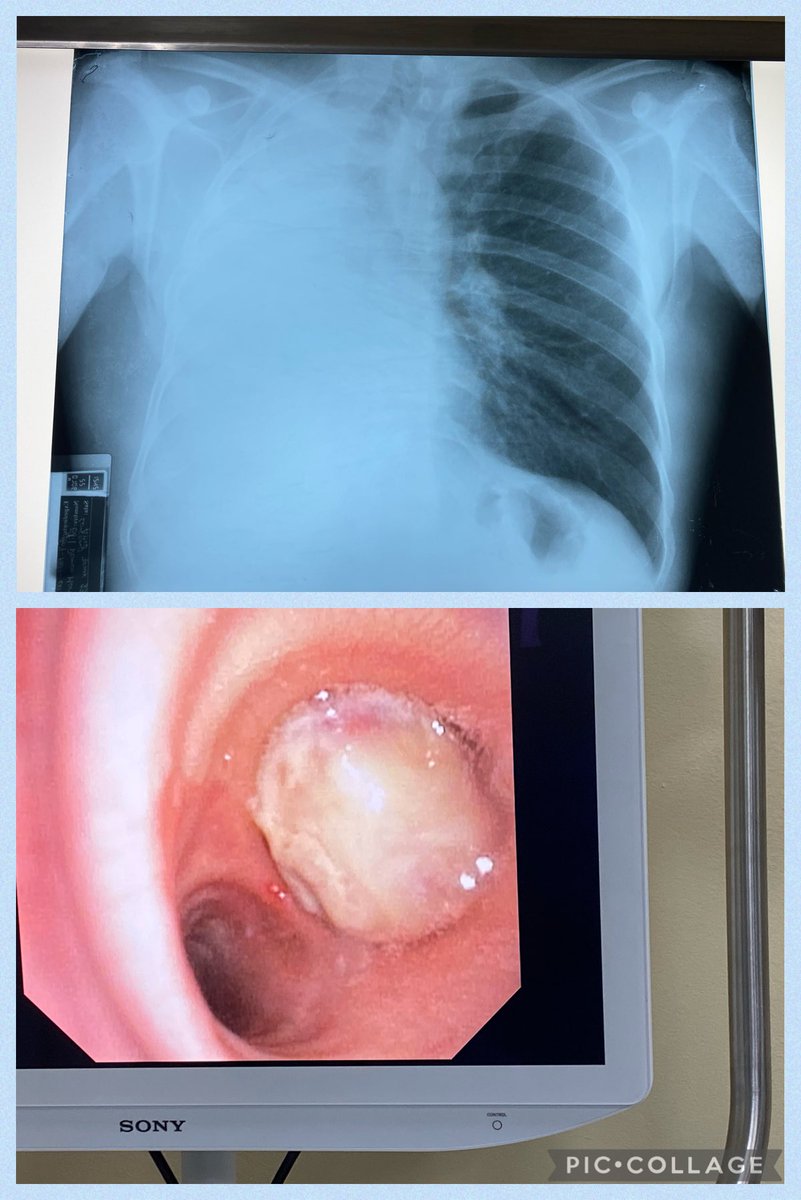 drasosa_'s tweet photo. Joven de 30 años, agricultor , sano con enorme tumor endobronquial derecha. Gana 100 lempiras al día. Como pagará una tomografía? Aún no solucionan nada Administrivamente de nuestro tomógrafo ni comida ni angiografo etc https://t.co/vvHAP2pp1q