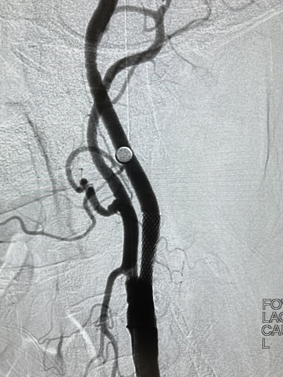6F Launcher JR4 is another option for CAS by TRA approach.
#RadialFirst #RadialForNeuro