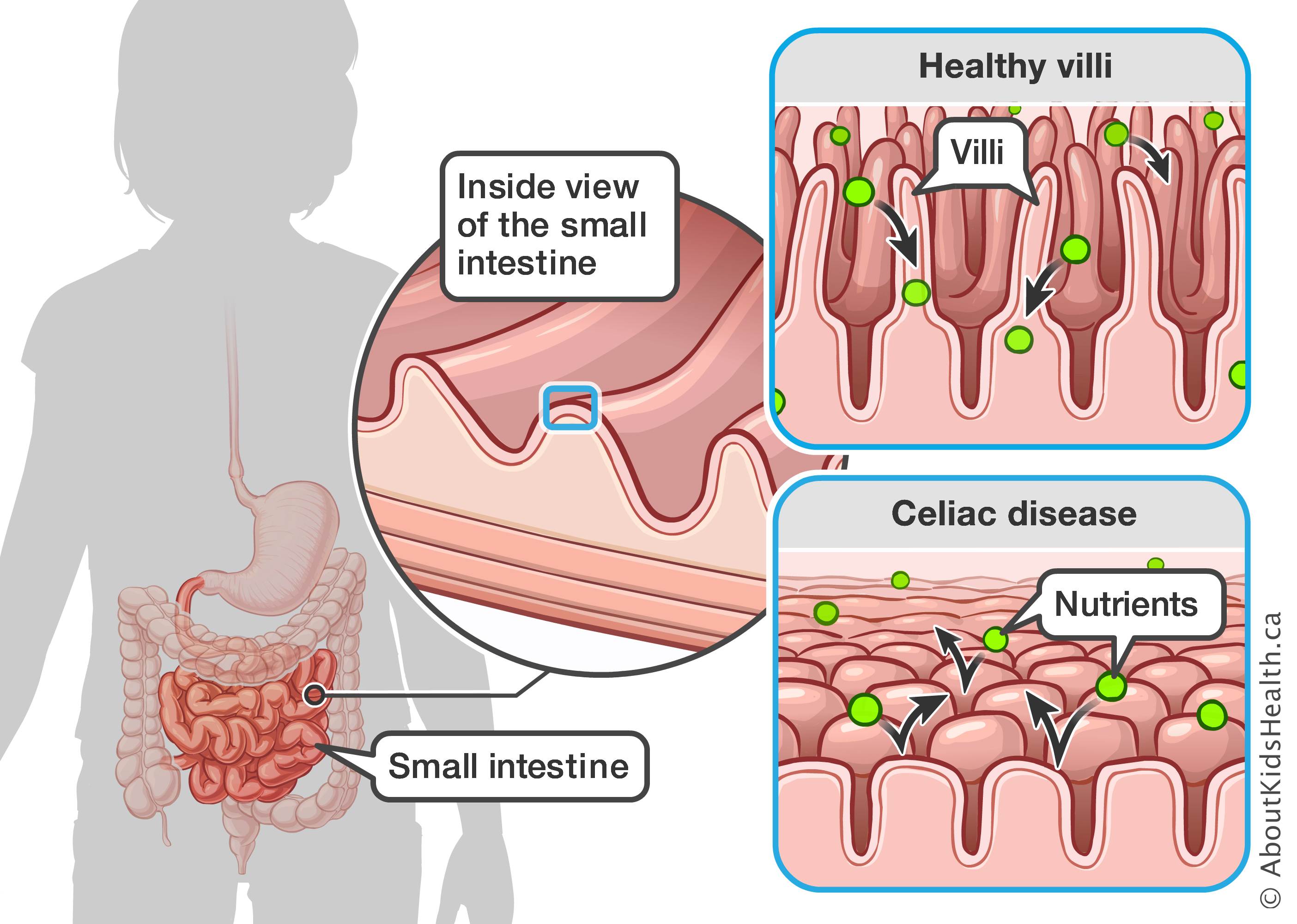 Que comer los celiacos